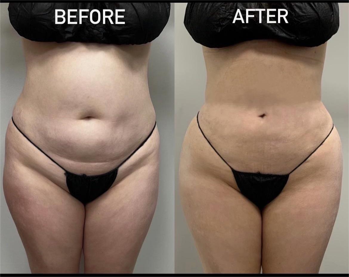 Before: Brazilian Butt Lift (BBL)